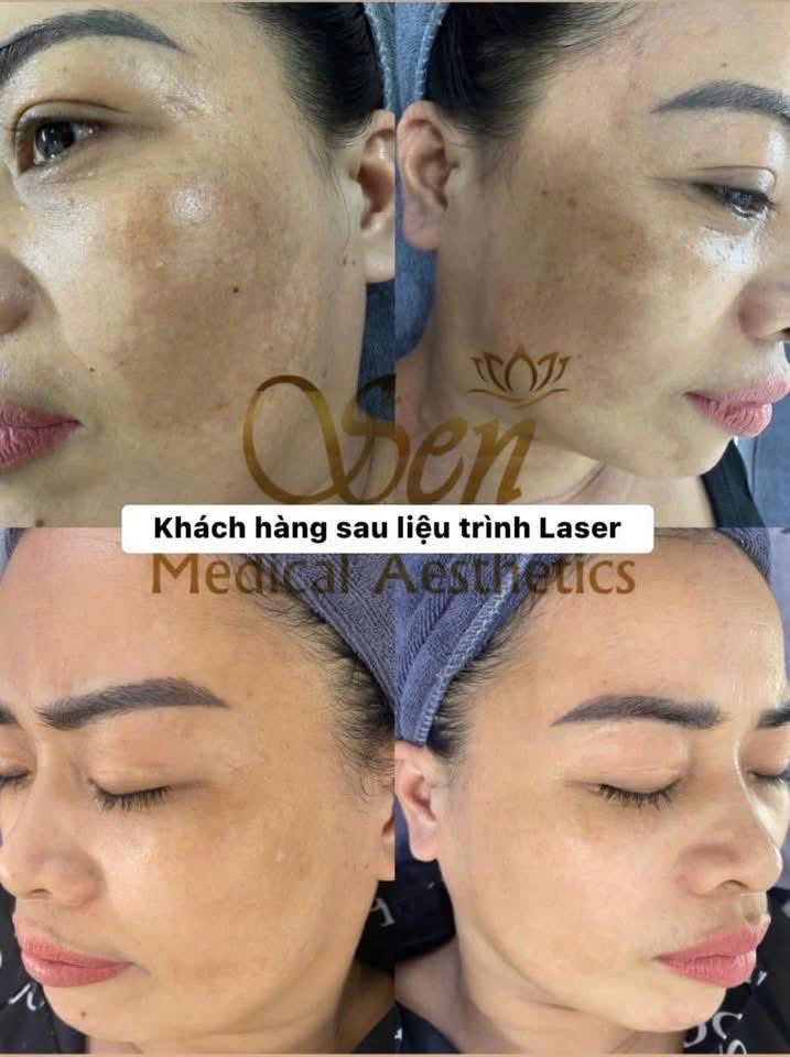 Khách hàng sau liệu trình Laser cải thiện nám tại Thẩm Mỹ Sen